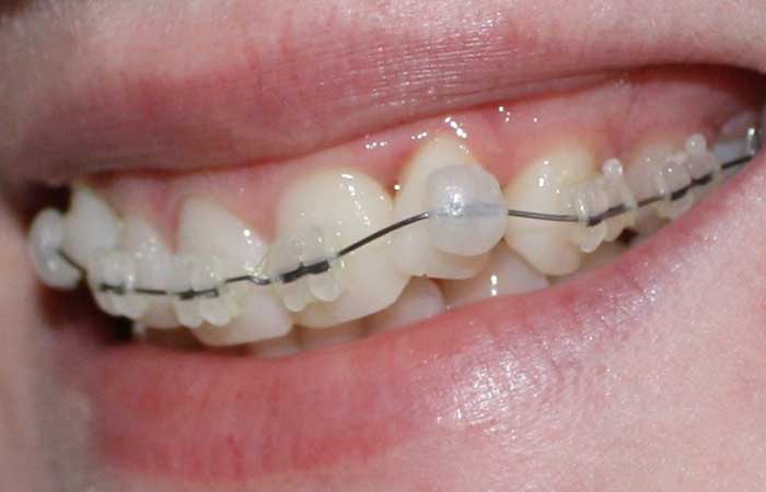 از کجا بفهمیم براکت ارتودنسی شکسته؟