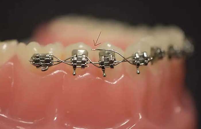 از کجا بفهمیم براکت ارتودنسی شکسته؟