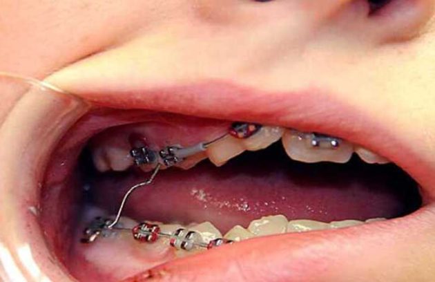 از کجا بفهمیم براکت ارتودنسی شکسته؟