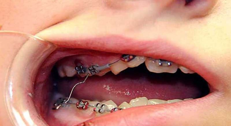 از کجا بفهمیم براکت ارتودنسی شکسته؟