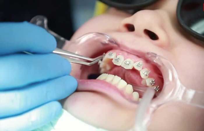 بهترین متخصص ارتودنسی کودکان در تهران قلهک