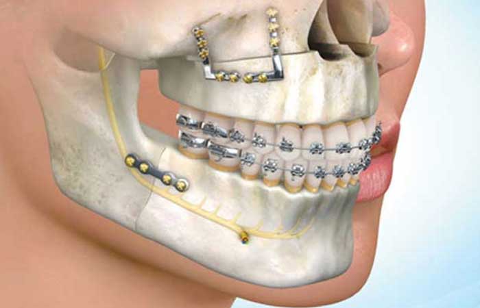 فرق ارتودنسی با ارتوسرجری
