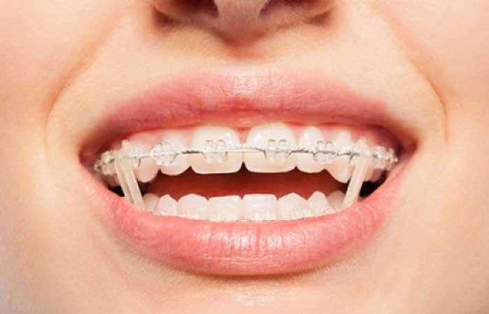 چرا در ارتودنسی کش استفاده می شود؟