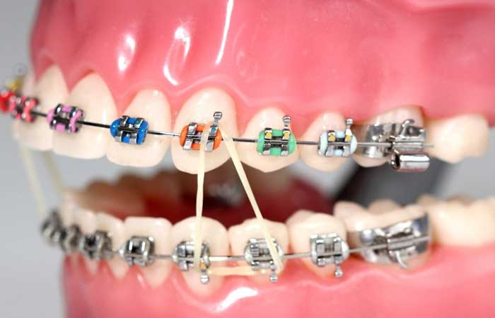 چرا در ارتودنسی کش استفاده می شود؟