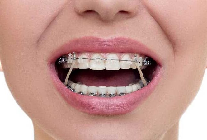 چرا در ارتودنسی کش استفاده می شود؟
