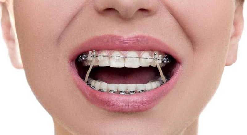 چرا در ارتودنسی کش استفاده می شود؟