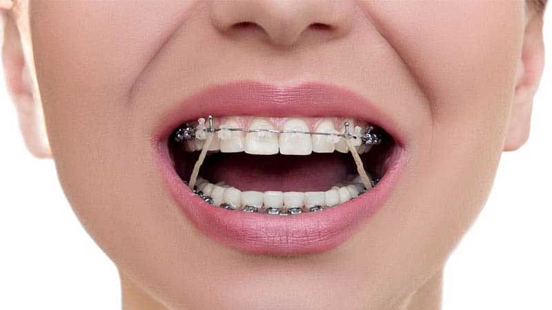 چرا در ارتودنسی کش استفاده می شود؟