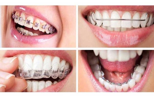 چه نوع ارتودنسی بهتر است؟