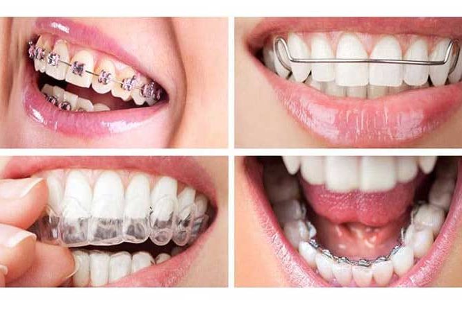 چه نوع ارتودنسی بهتر است؟