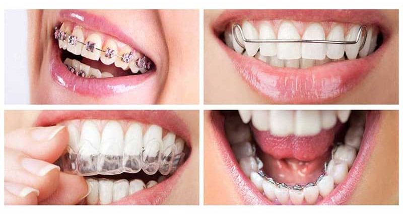 چه نوع ارتودنسی بهتر است؟