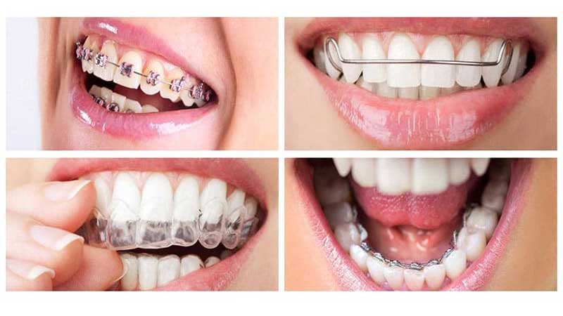 چه نوع ارتودنسی بهتر است؟