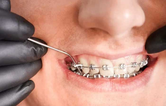 قیمت ارتودنسی ثابت برای دو فک