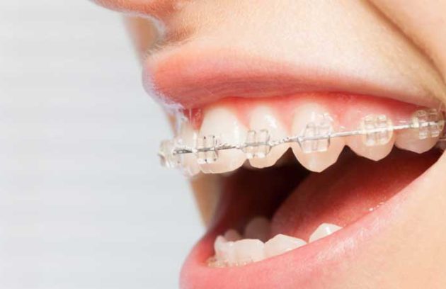 ارتودنسی ثابت اقساطی