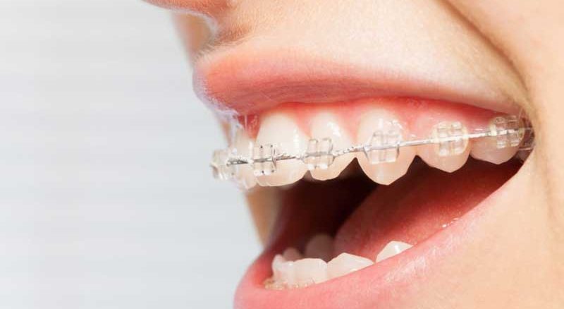 ارتودنسی ثابت اقساطی