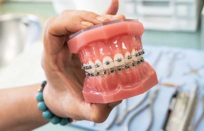 قیمت ارتودنسی ثابت برای دو فک