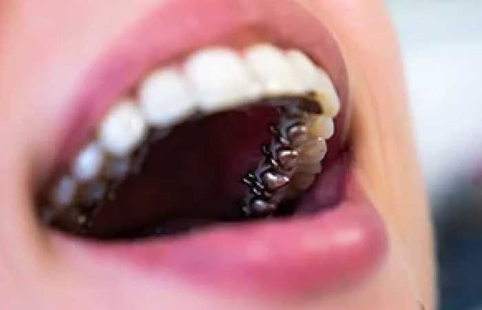 انواع ارتودنسی ثابت