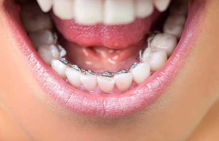 ارتودنسی ثابت پشت دندان