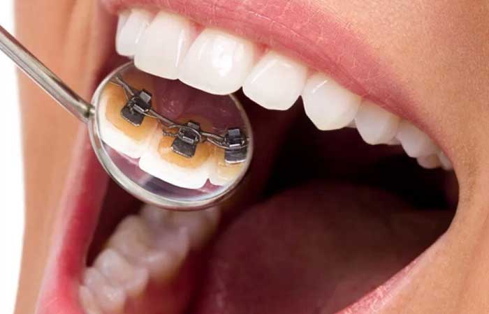 ارتودنسی ثابت پشت دندان