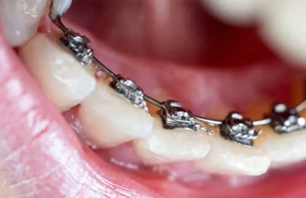 ارتودنسی ثابت پشت دندان