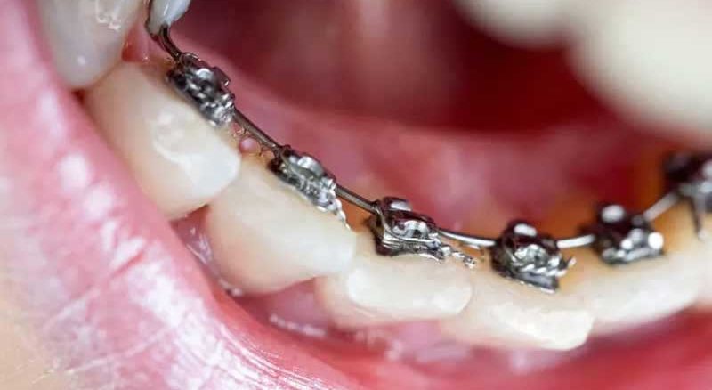 ارتودنسی ثابت پشت دندان