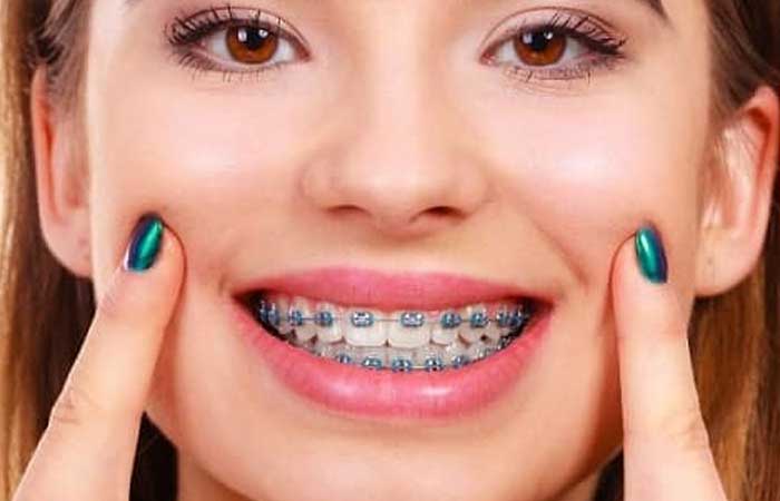 تاثیر ارتودنسی ثابت بیشتر است یا متحرک