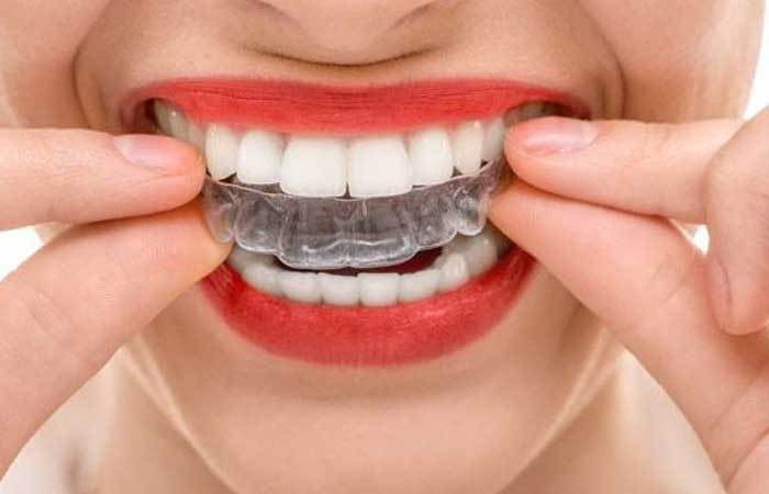 انواع ارتودنسی متحرک