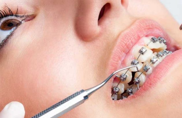 انواع ارتودنسی