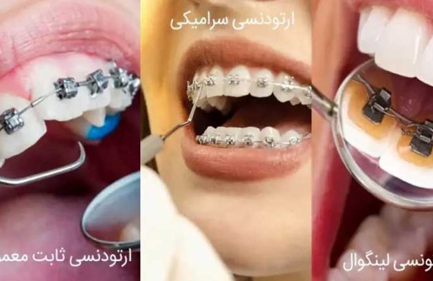 انواع ارتودنسی ثابت