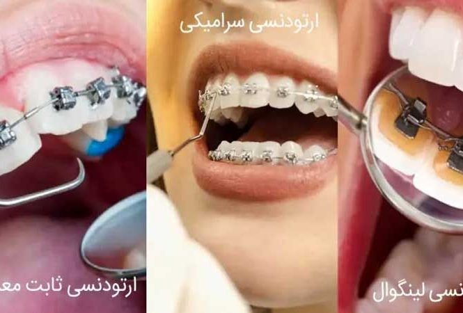 انواع ارتودنسی ثابت