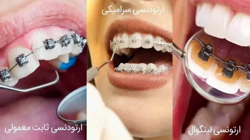 انواع ارتودنسی ثابت