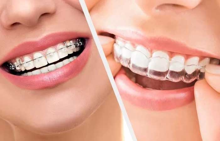 تاثیر ارتودنسی ثابت بیشتر است یا متحرک