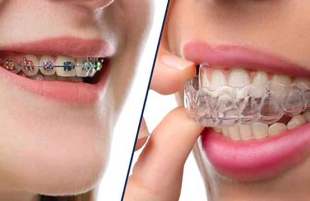 تاثیر ارتودنسی ثابت بیشتر است یا متحرک
