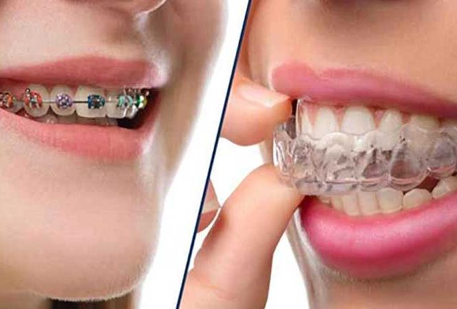 تاثیر ارتودنسی ثابت بیشتر است یا متحرک