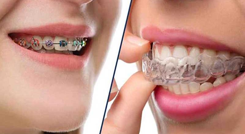 تاثیر ارتودنسی ثابت بیشتر است یا متحرک