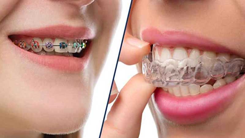تاثیر ارتودنسی ثابت بیشتر است یا متحرک