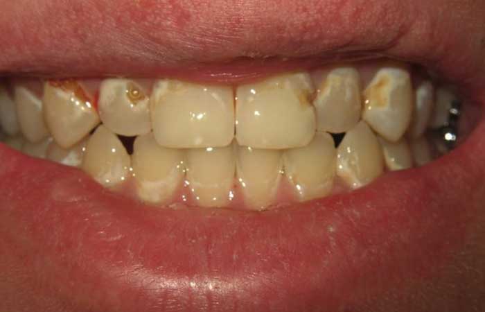 عوارض ارتودنسی ثابت