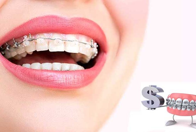 شرایط بیمه ارتودنسی تکمیلی