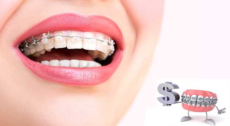 شرایط بیمه ارتودنسی تکمیلی