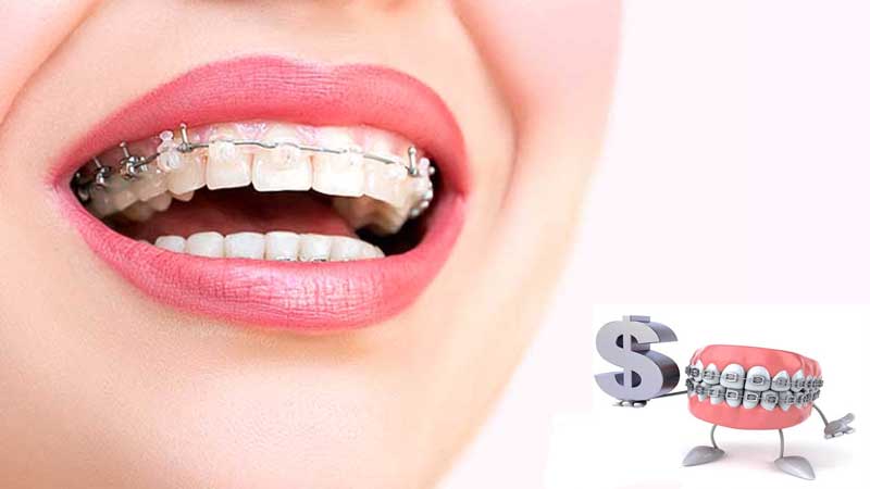 شرایط بیمه ارتودنسی تکمیلی