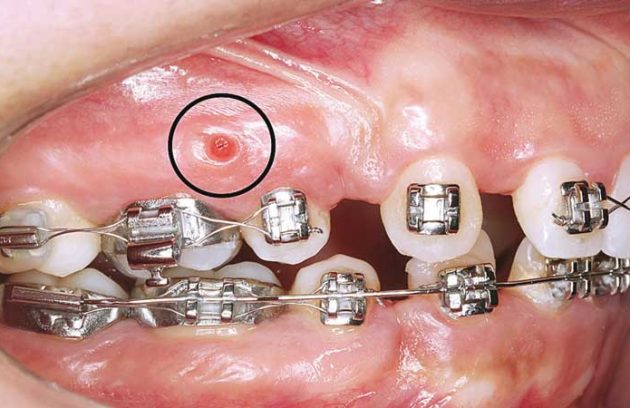 عوارض ارتودنسی ثابت