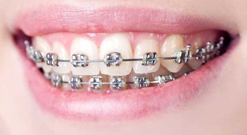 قیمت ارتودنسی ثابت برای دو فک