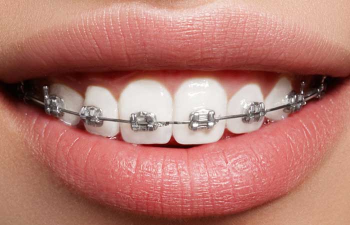 قیمت ارتودنسی ثابت تک فک