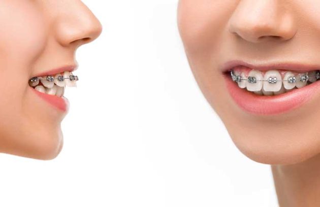 قیمت ارتودنسی ثابت تک فک