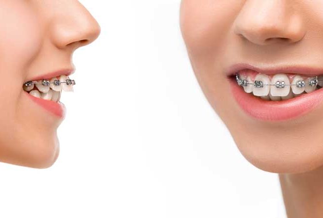 قیمت ارتودنسی ثابت تک فک