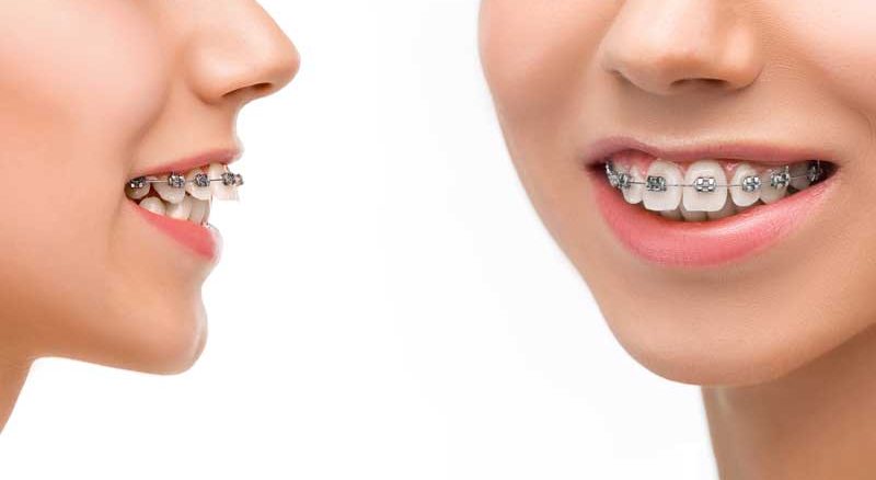 قیمت ارتودنسی ثابت تک فک