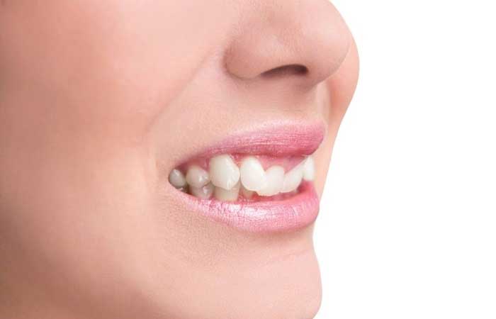قیمت ارتودنسی ثابت تک فک