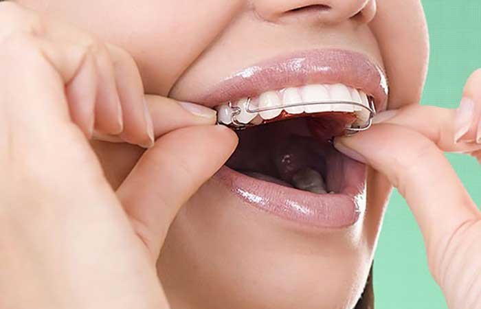 تاثیر ارتودنسی ثابت بیشتر است یا متحرک