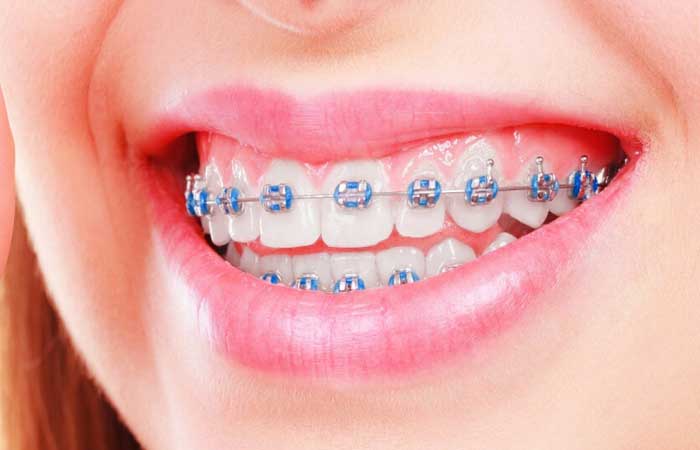 شرایط بیمه ارتودنسی تکمیلی