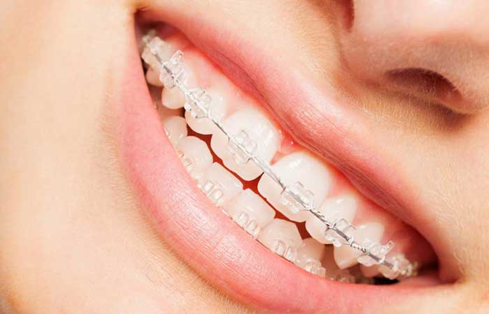 انواع ارتودنسی ثابت