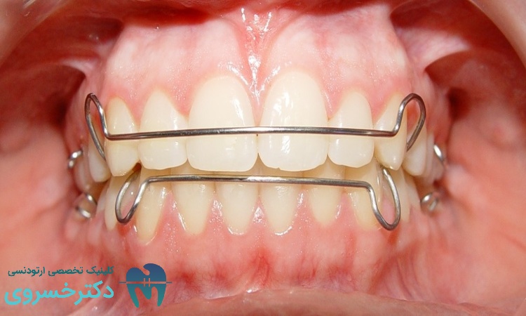 درمان با ارتودنسی متحرک
